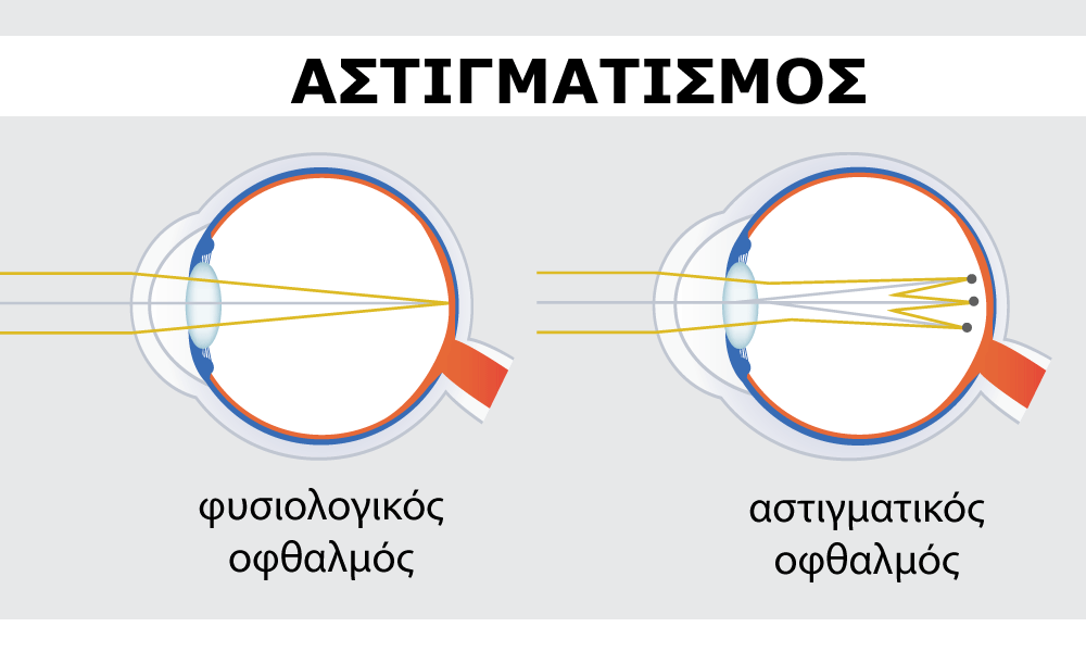 αστιγματισμος 